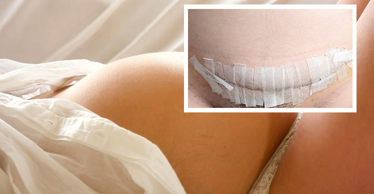 婦產科醫師：剖腹產後敷料真的不用蓋那麼久