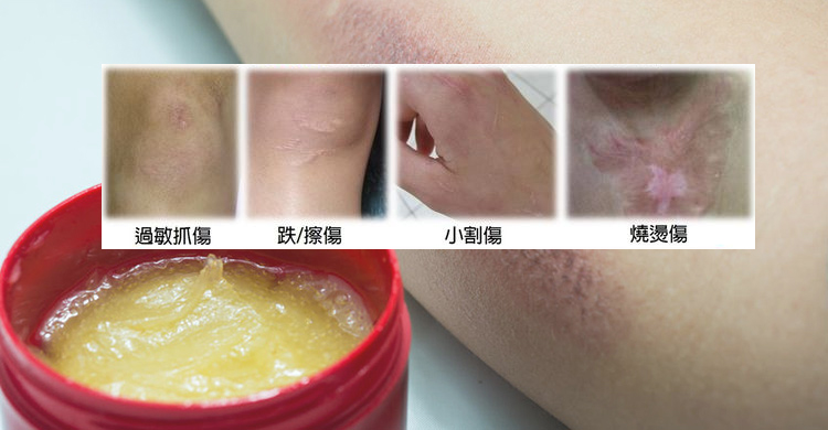 單一方向塗抹！藥師詳解矽膠除疤凝膠使用與挑選