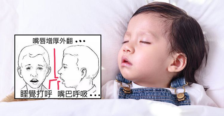 小孩睡覺打呼好可愛？長期導致嘴唇肥厚外翻和暴牙