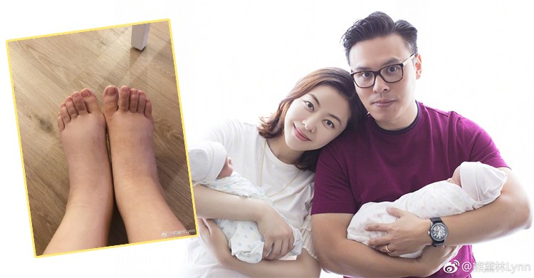 熊黛林產女美腿腫成豬蹄！擾人產後水腫怎麼解？