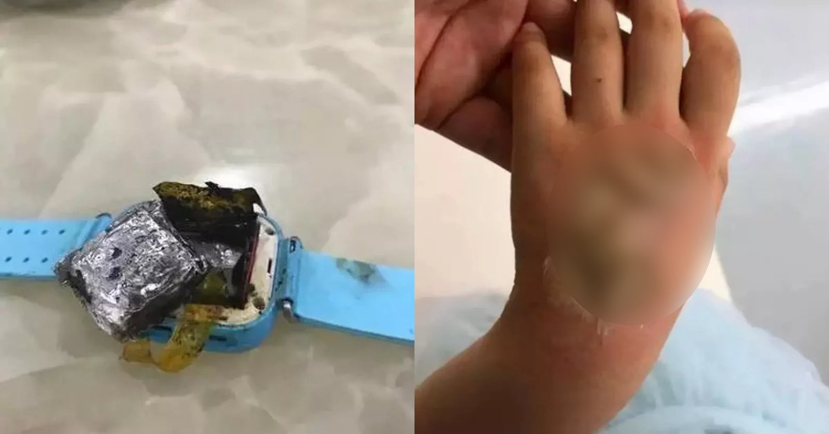 智慧型手錶,小孩燙傷,燒傷,爆炸
