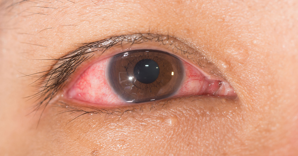 慢性結膜炎,眼睛 異物感,結膜炎,眼睛癢,過敏性結膜炎,急性結膜炎,眼睛過敏,眼睛有異物感,結膜炎症狀,結膜炎 傳染,眼睛刺痛