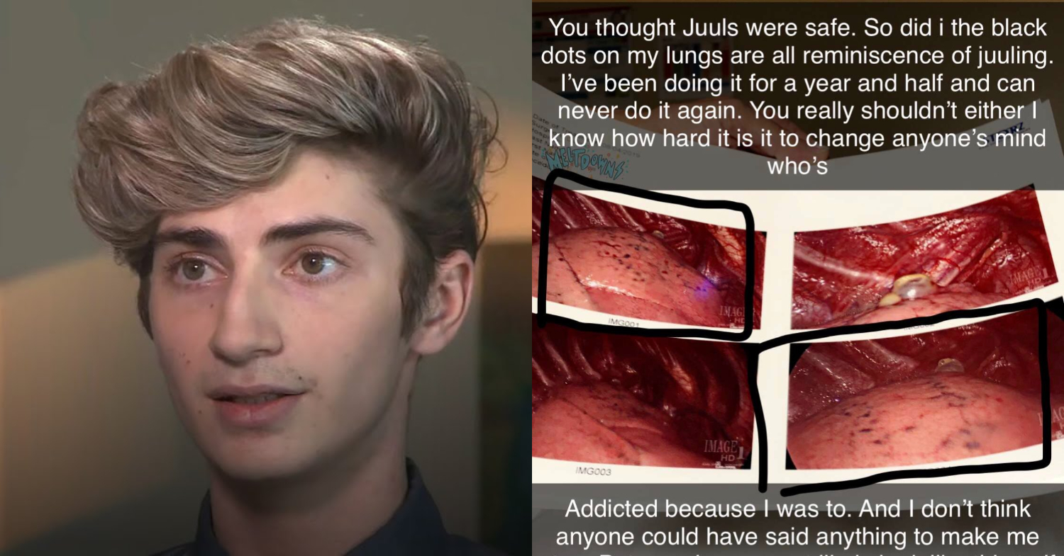 18歲男抽電子菸「左肺全塌」，揭開電子菸的恐怖真相