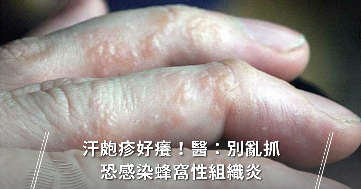 汗皰疹,泡疹,濕疹藥膏,汗皰疹藥膏,疹子,濕疹照片,蜂窩性組織炎,蜂窩性組織炎症狀,