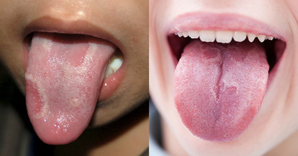 新冠舌頭,染疫,新型冠狀病毒,舌頭,發炎,兒童染疫,兒童確診,兒童染疫症狀